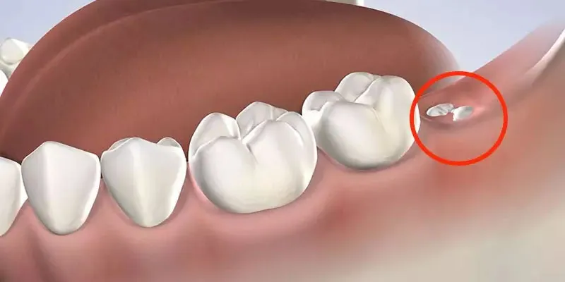Cùng Kubet tìm hiểu về mơ bị nhổ răng
